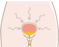 continuous incontinence